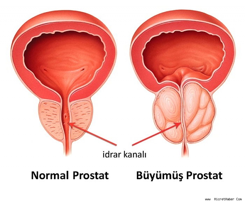 prostat-buyumesi-turan-klinik-op-dr-umut-turan