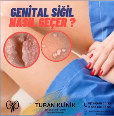 Genital siğil